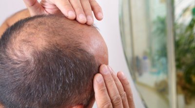 مرشح للإنتخابات الرئاسية يعد بتقديم علاج للصلع 