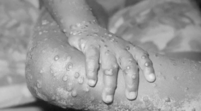 د.حاتم الغزال يحذر من تحول ''جدري القردة'' إلى وباء عالمي 