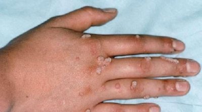 تونس خالية من مرض 'جدري القردة'