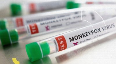 بعد إرتفاع عدد الإصابات بجدري القرود..دكتور حاتم الغزال يحذر 