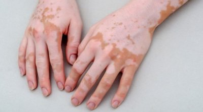 د.حاتم الغزال : منح ترخيص لدواء يعالج البهاق لأوّل مرة في التاريخ