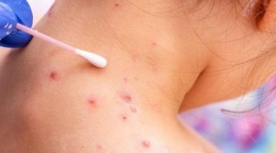 يشتبه في إصابتها بجدري القردة..صدور نتائج التّحاليل المخبريّة لفتاة بصفاقس