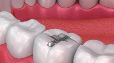 وزارة الصحة تمنع إستعمال ملغم الأسنان