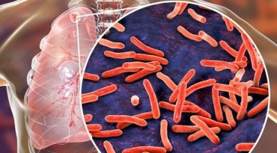 طبيب تونسي يطلق صيحة فزع : السل عاد بقوة 