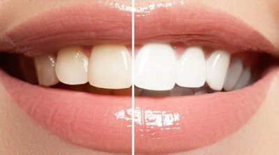 Blanchiment des dents : les autorités mettent en garde contre les centres non autorisés