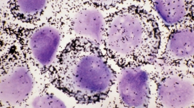 تسجيل 369 حالة إصابة بالالتهاب الكبدي الفيروسي صنف أ في سنة 2013