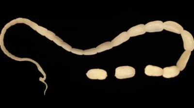 الكاف : اكتشاف دودة شريطية طولها 3 امتار داخل بطن طفلة الـ8 سنوات 