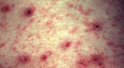 ماطر :إغلاق مدرسة إعدادية ومبيت بسبب إصابة 40 تلميذا بداء الجرب