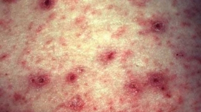 باجة : إصابة 7 تلاميذ بداء الجرب بالمدرسة الإبتدائية بحي الذهبية