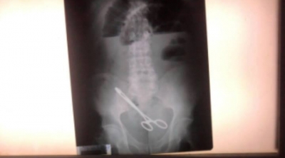 بعد اجرائه لعملية جراحية في مستشفى الرابطة : العثور على مقص طبي في معدة مريض 