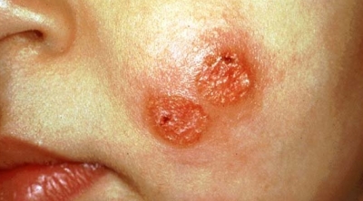 تسجيل 144 اصابة بمرض ''حبة الفأرة'' في ولاية القيروان