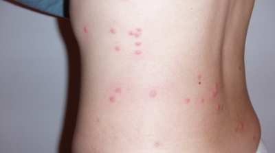 اغلاق مدرسة ابتدائية في بنزرت بسبب انتشار ''البرغوث''