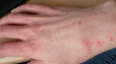 بنزرت : تسجيل اصابة 10 تلاميذ بداء الجرب في مدرسة ابتدائية بغار الملح