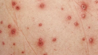 Kairouan : 11 cas de rougeole à l'hôpital Ibn Jazzar