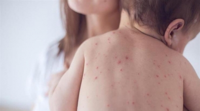 12 bébés atteints de rougeole admis à l’hôpital de Kairouan