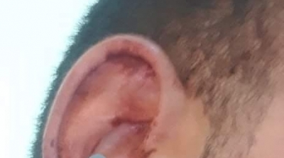 فظيع : في بنزرت ...مواطن يقطع أذن سائق حافلة لأنه منعه من الصعود